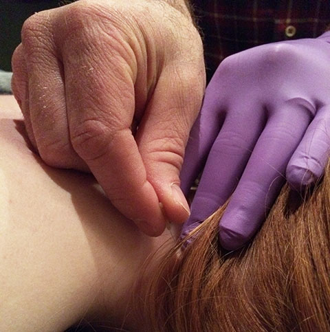 Dry Needling is an effective treatment for Acute Neck Pain