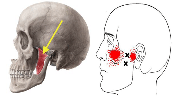 Lateral pterygoid muscle with associated trigger points demonstrating referred pain