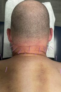 Dry needling to neck for cervicogenic vertigo relief at Northern Edge PT